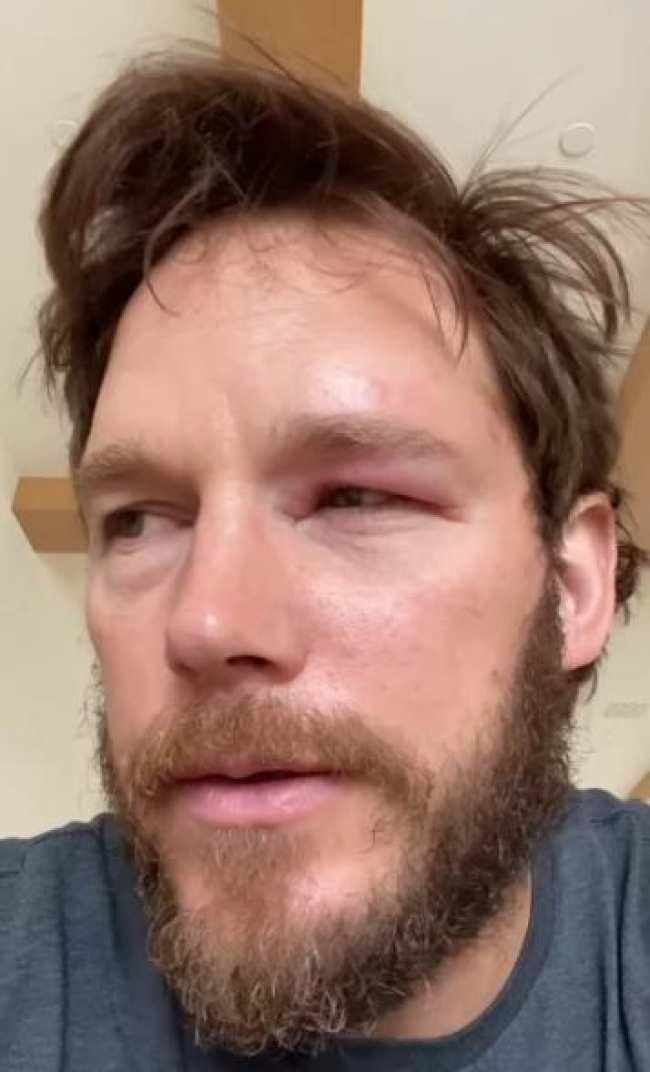 Chris Pratt con un ojo hinchado