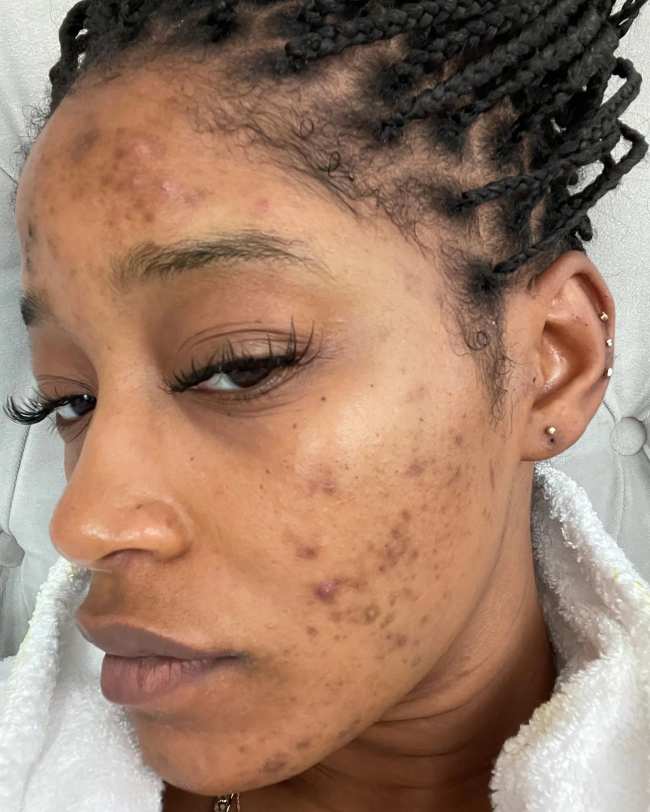              The Nope star has been open about her acne struggles in the past             