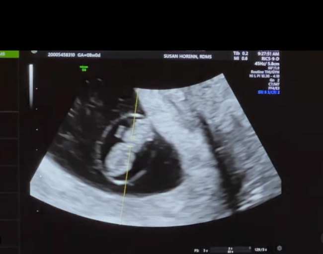 Una captura de pantalla del ultrasonido de Tia Blanco