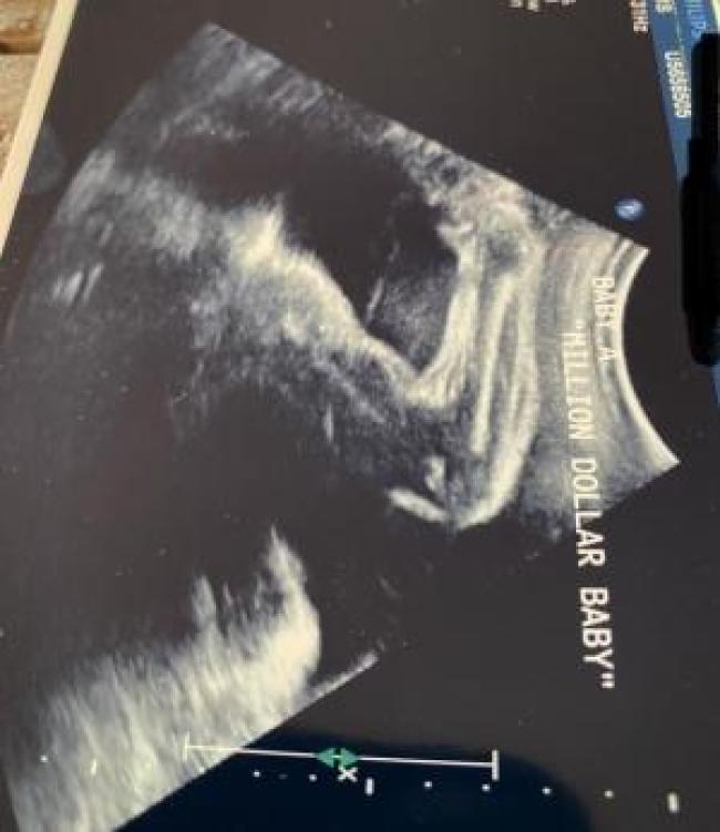El bebe de Hilary Swank flexionando en una foto de ultrasonido