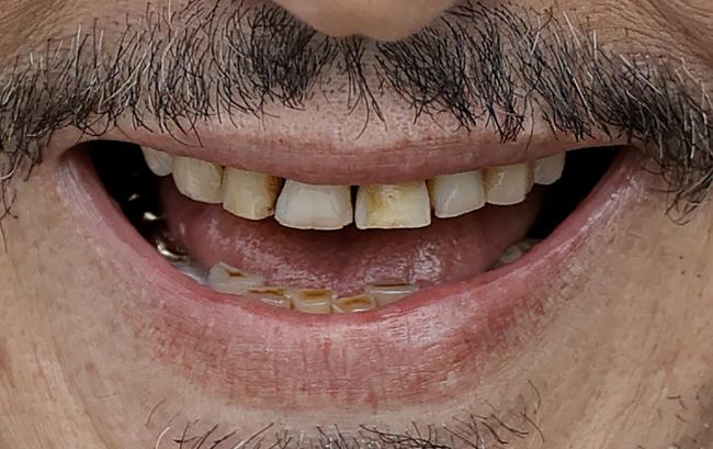 Un dentista famoso le dijo a QQCQ Style que los dientes del actor no se están deteriorando, sino que simplemente se están desgastando.