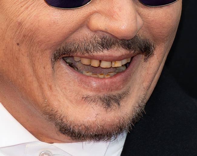 Los dientes de Depp parecían descoloridos y plagados de manchas marrones.