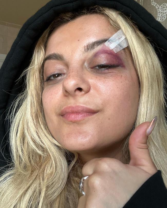 Rexha reveló previamente que el incidente del teléfono en la ciudad de Nueva York la dejó con un ojo morado.