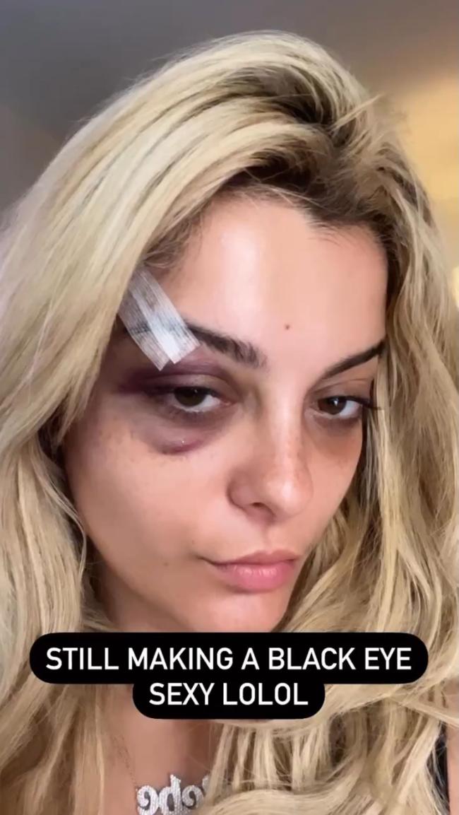 El asistente al concierto fue arrestado y acusado por el incidente, que requirió que Rexha recibiera puntos de sutura.