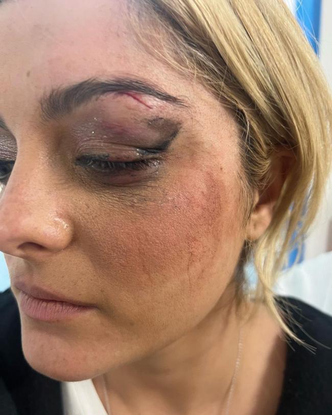 En una serie de incidentes recientes en los que los fanáticos arrojaron objetos al escenario, Bebe Rexha sufrió un ojo morado por un teléfono celular que volaba.