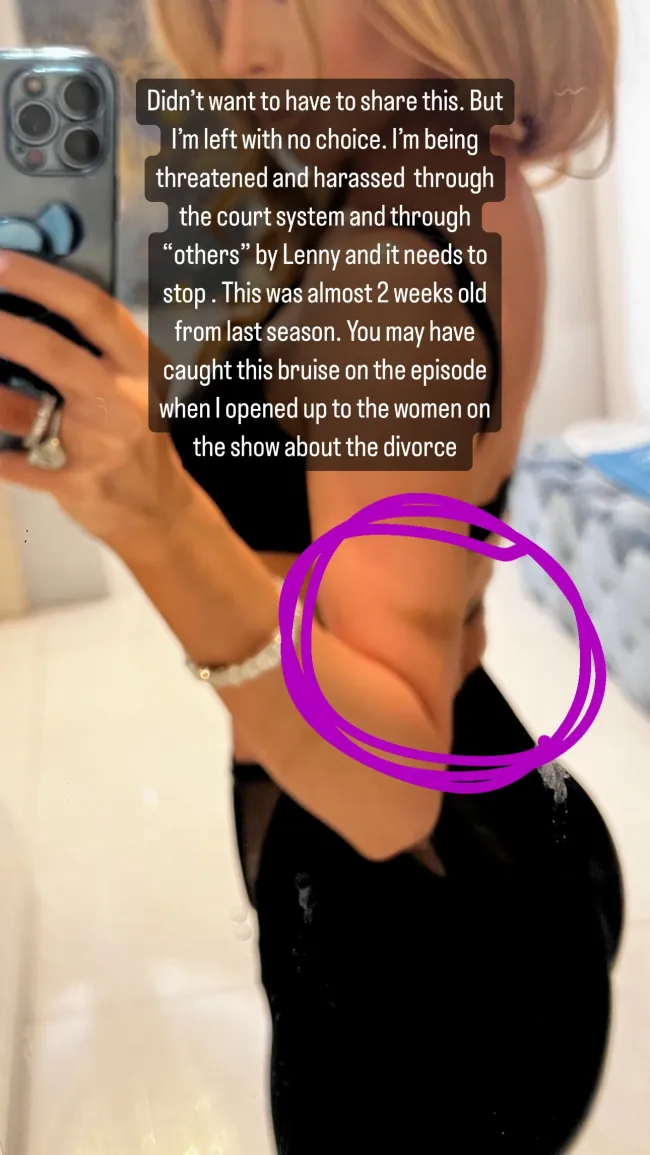 La estrella de “Real Housewives of Miami” publicó una foto de su hematoma en su historia de Instagram.