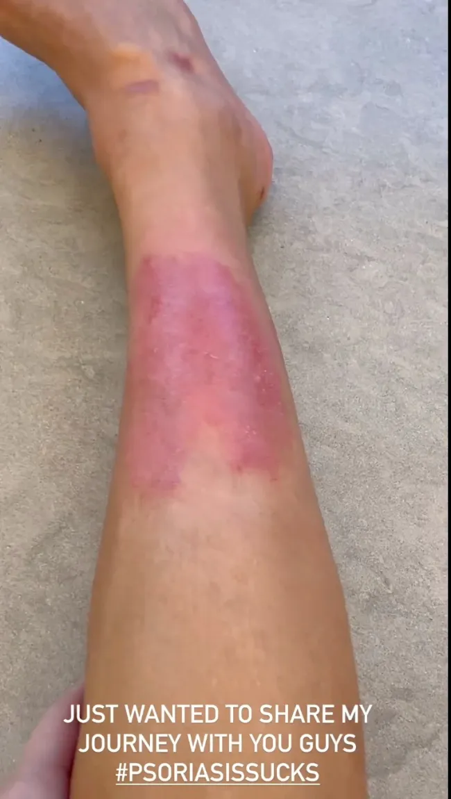 La psoriasis de Kim Kardashian en su pierna.