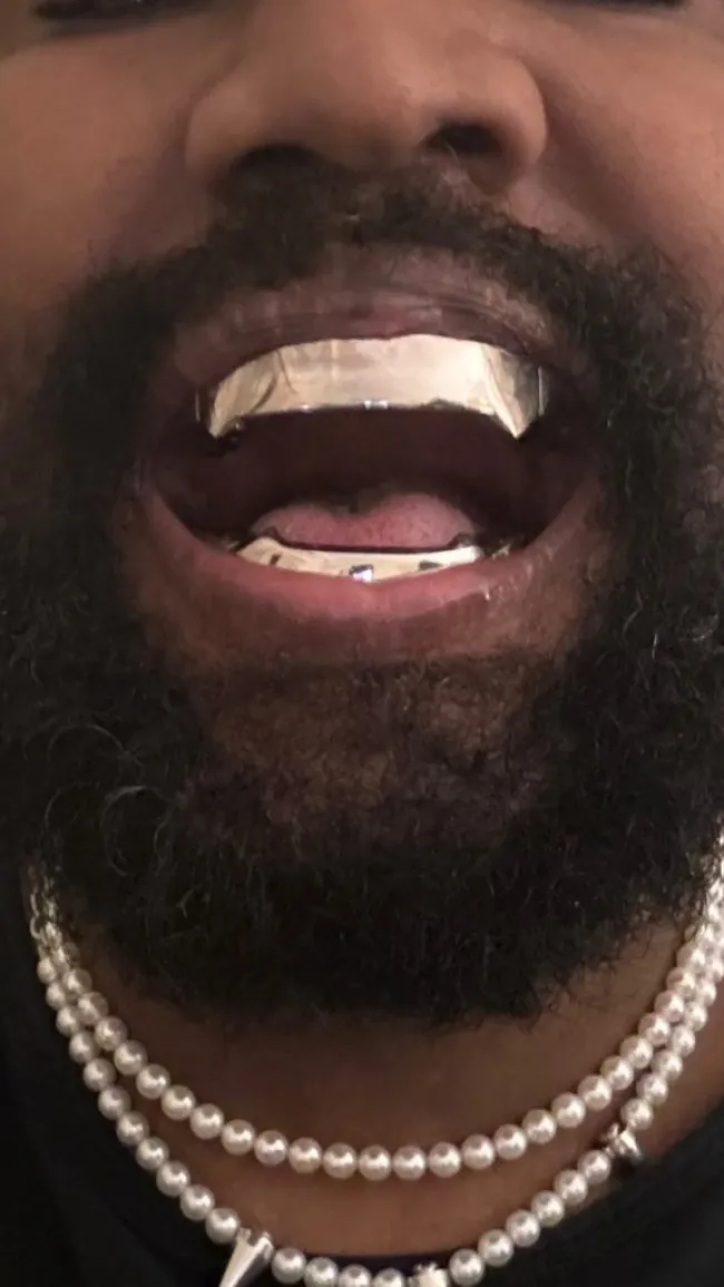 Primer plano de los dientes de Kanye West con dentaduras postizas de titanio.