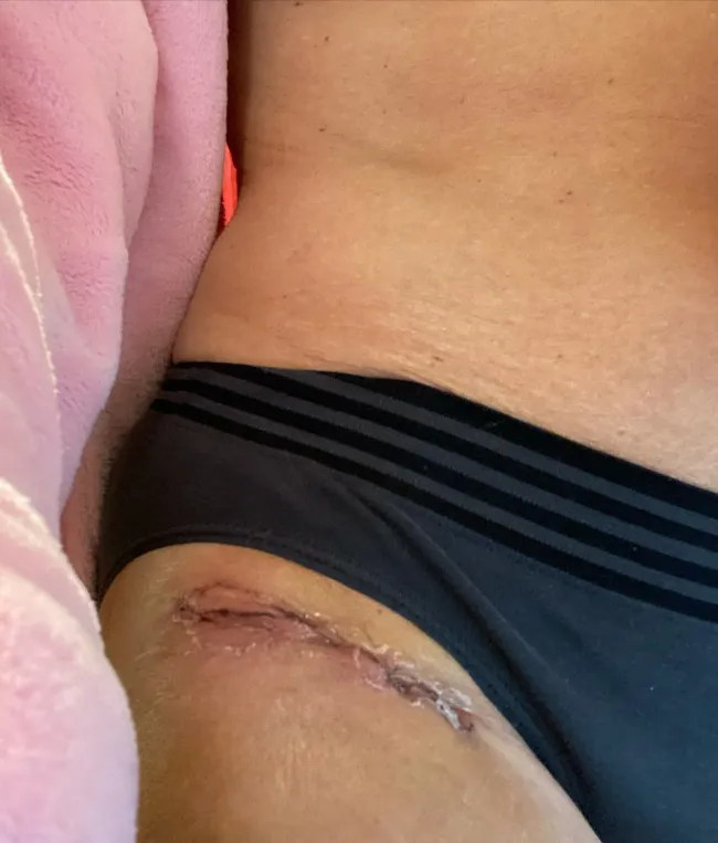 La cicatriz de la cadera de Paulina Porizkova