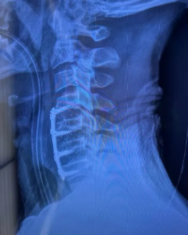 Radiografía del cuello de Val Chmerkovskiy