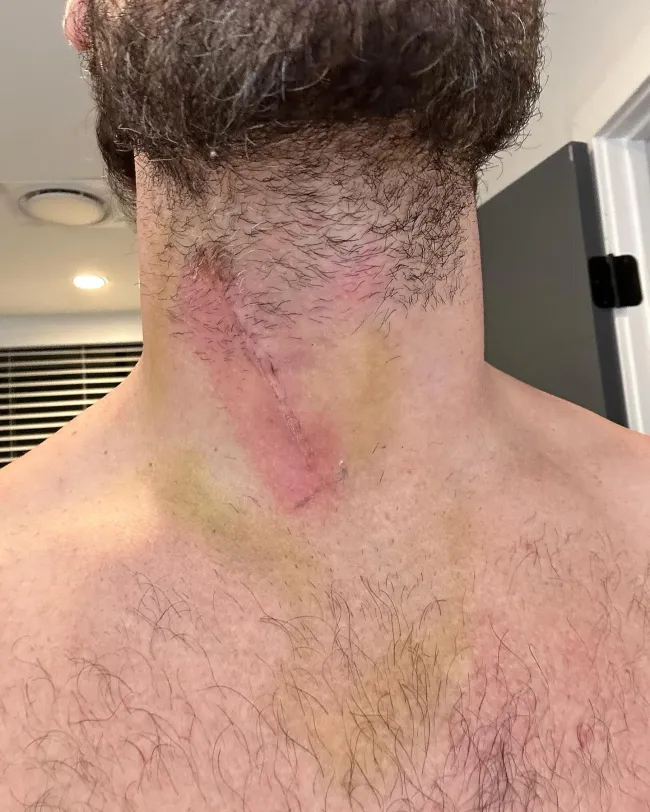 La cicatriz de Val Chmerkovskiy en el cuello