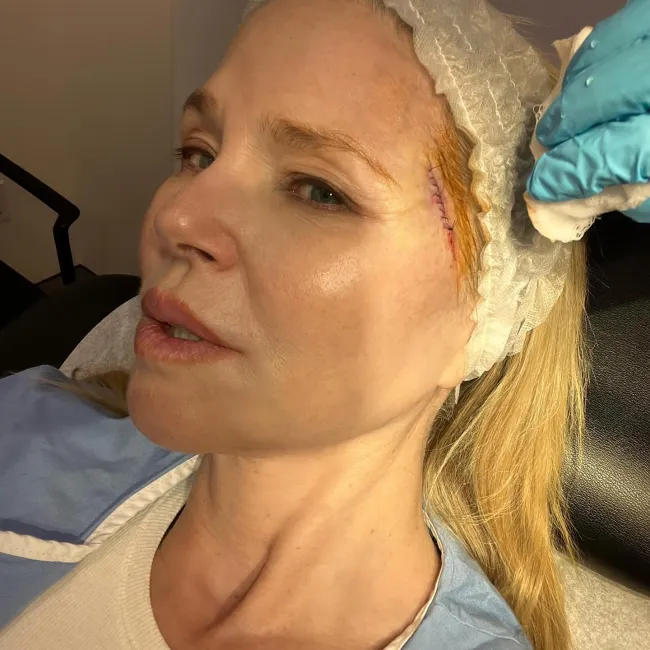 Cirugía de cáncer de piel de Christie Brinkley