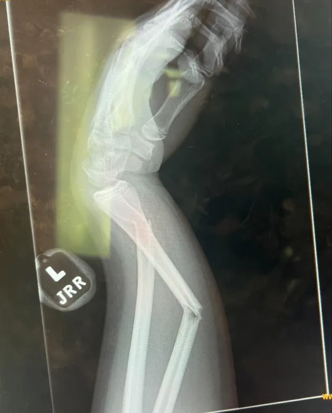 Radiografía de brazo roto.